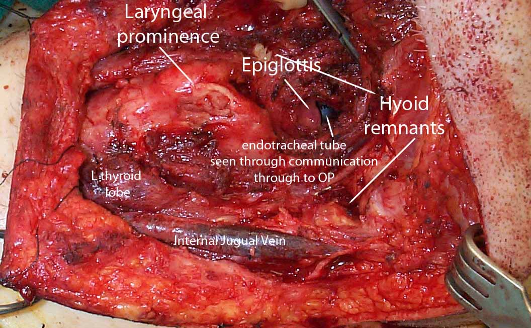 Surgical site after removal of thyroglossal duct cyst at time of 3rd procedure (2nd revision) Surgical site after removal of thyroglossal duct cyst at time of 3rd procedure (2nd revision)
