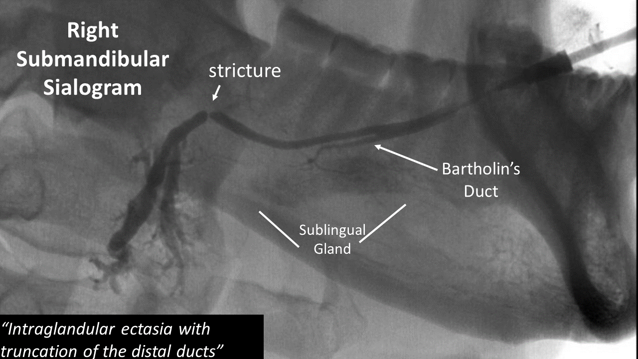 Sialogram Of Submandibular Duct Stricture With Bartholins Duct Iowa 