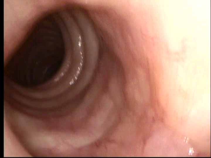 lx%20amyloid%20Nov%202010%20c.jpg lx%20amyloid%20Nov%202010%20c.jpg