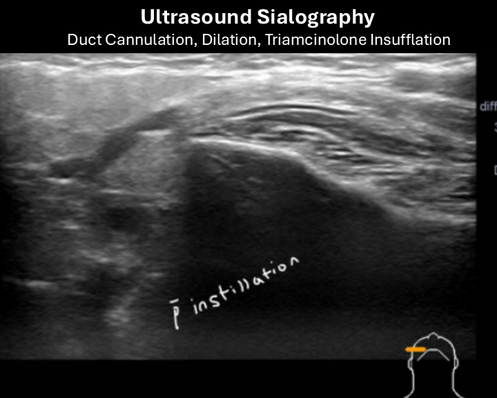 ultrasound sialography 3
