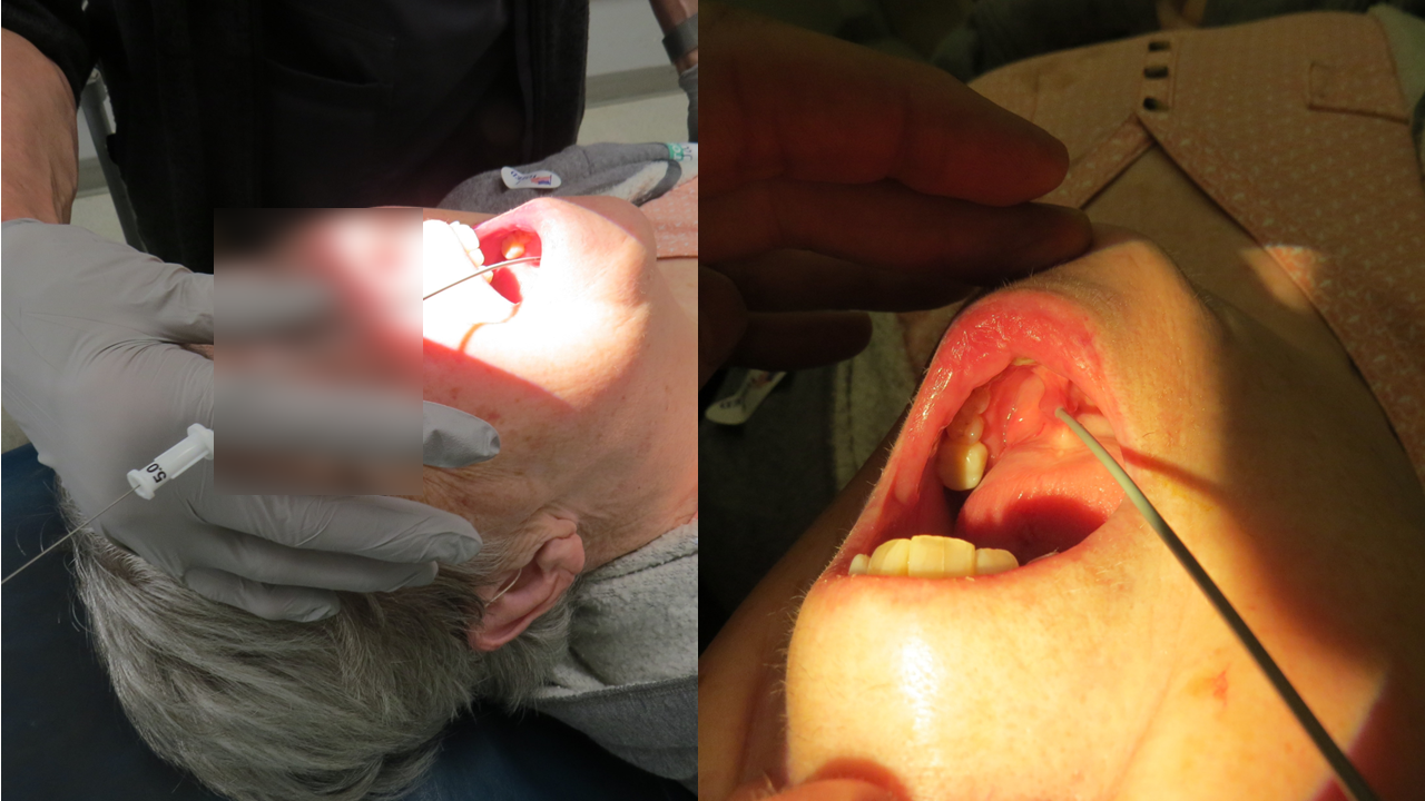 duct cannulation in clinic