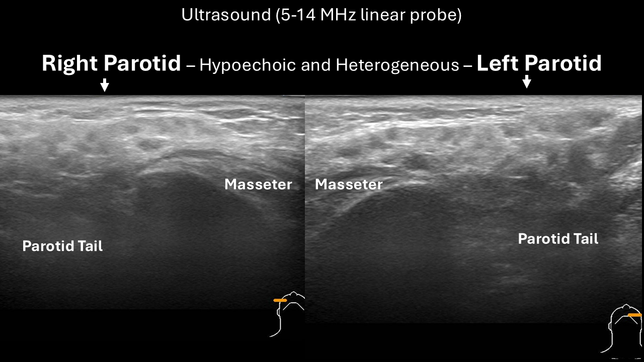 sialogram ultrasound