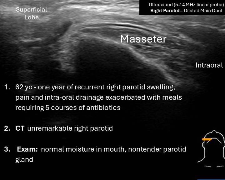 POCUS right parotid sialadenitis