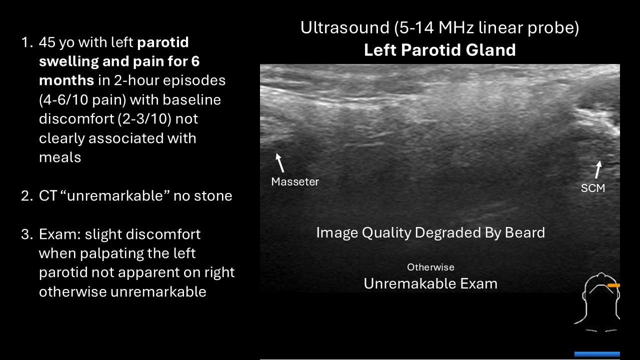 left parotid ultrasound