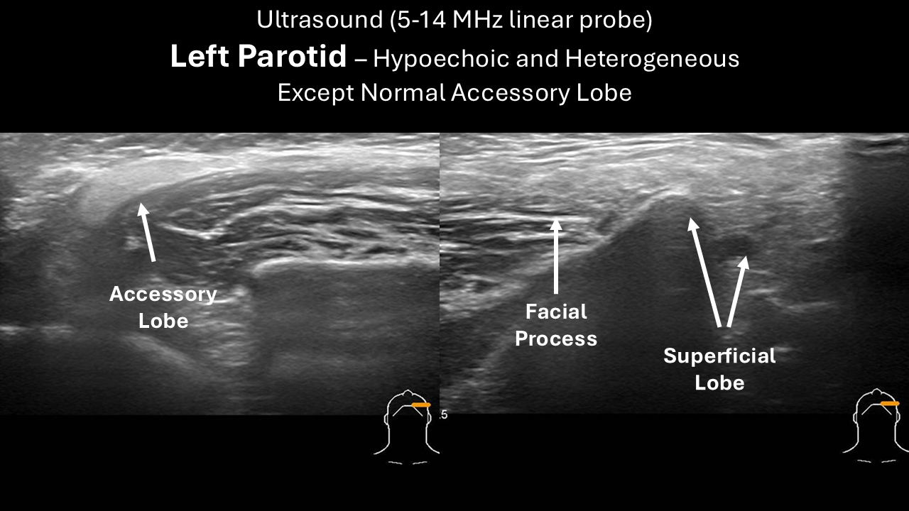 Ultrasound after I131 Left Parotid 