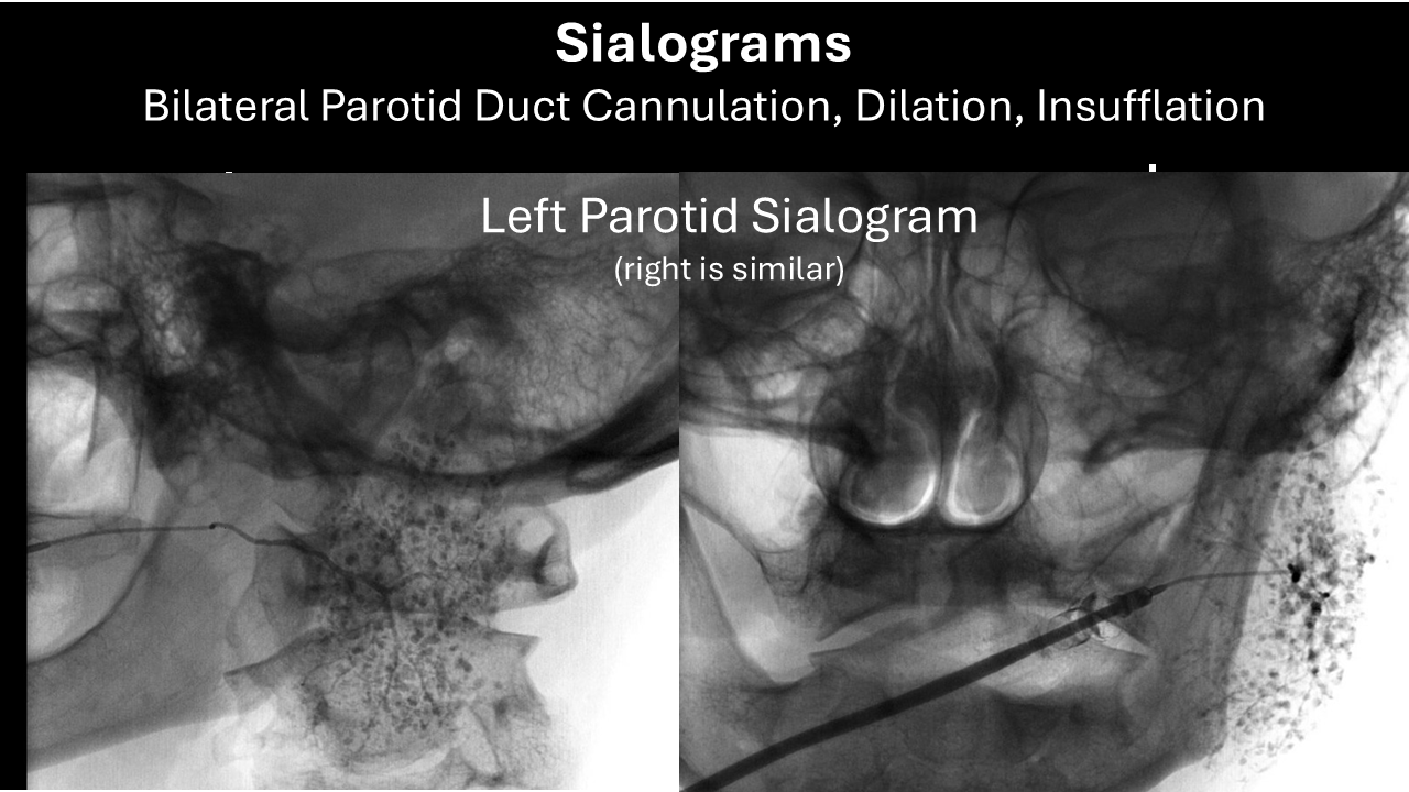 Sjogrens sialogram