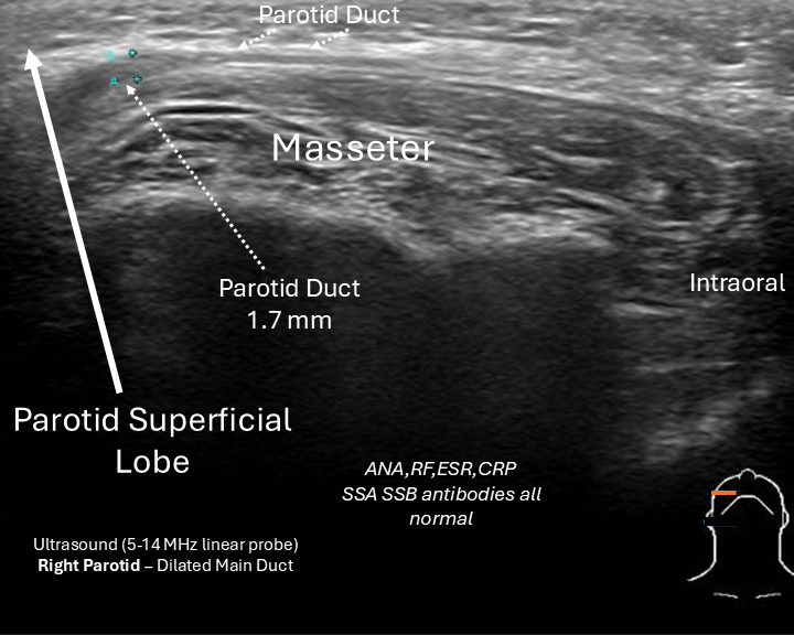POCUS right parotid sial 2