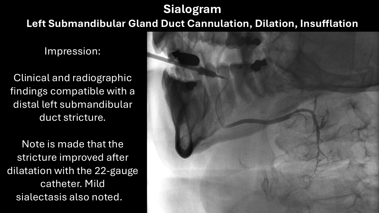 sialogram 2