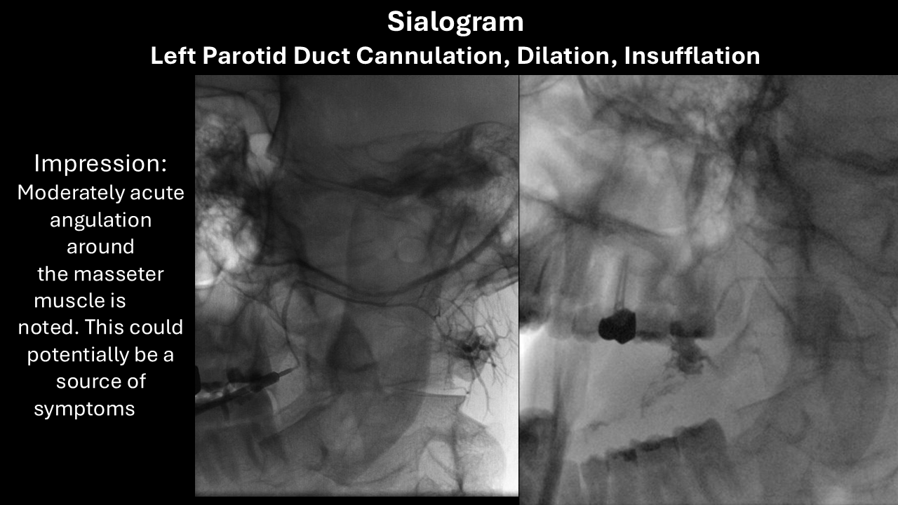 left parotid sialogram
