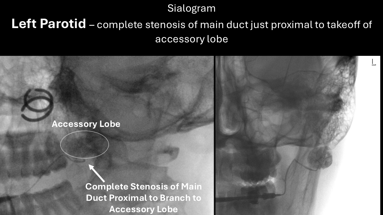 Left parotid sialogram I131