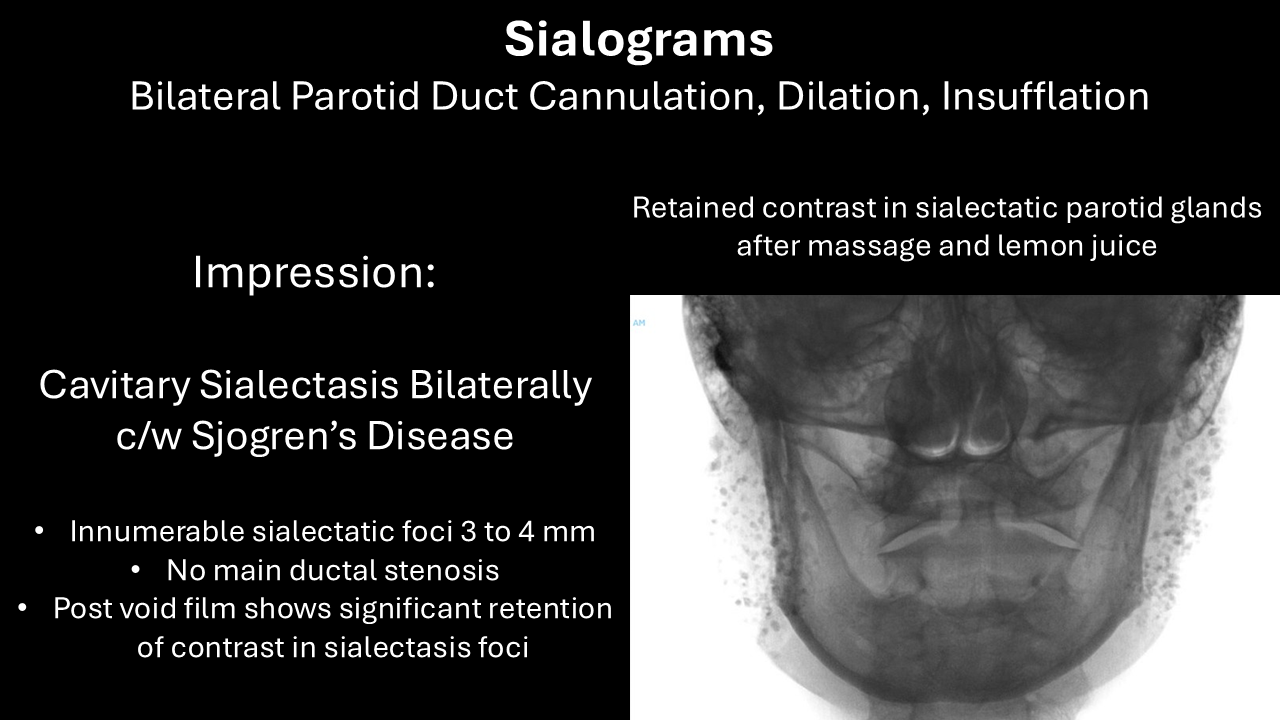 sialogram sjogrens post void