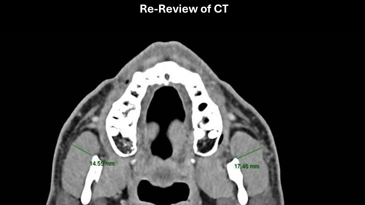 CT masseter enlargement