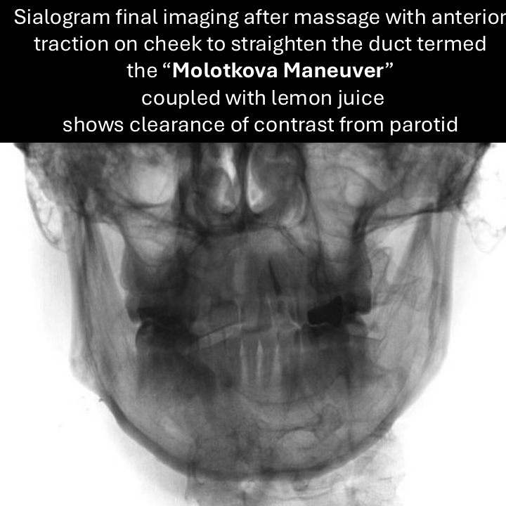 clearance on sialography with molotkova maneuver