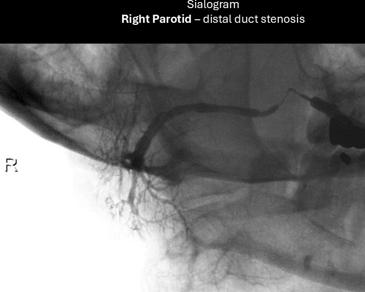 right parotid sialogram 1