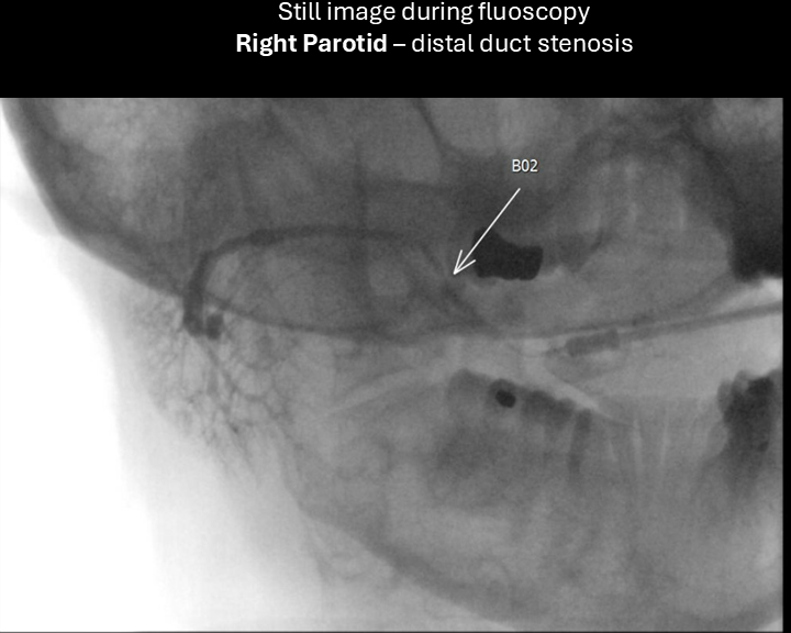 right parotid sialogram 2