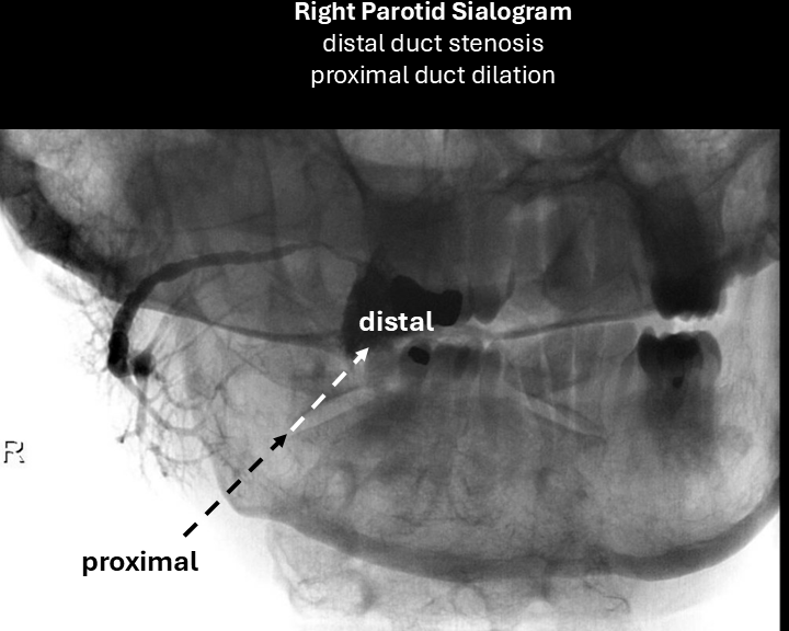 right sialogram 3