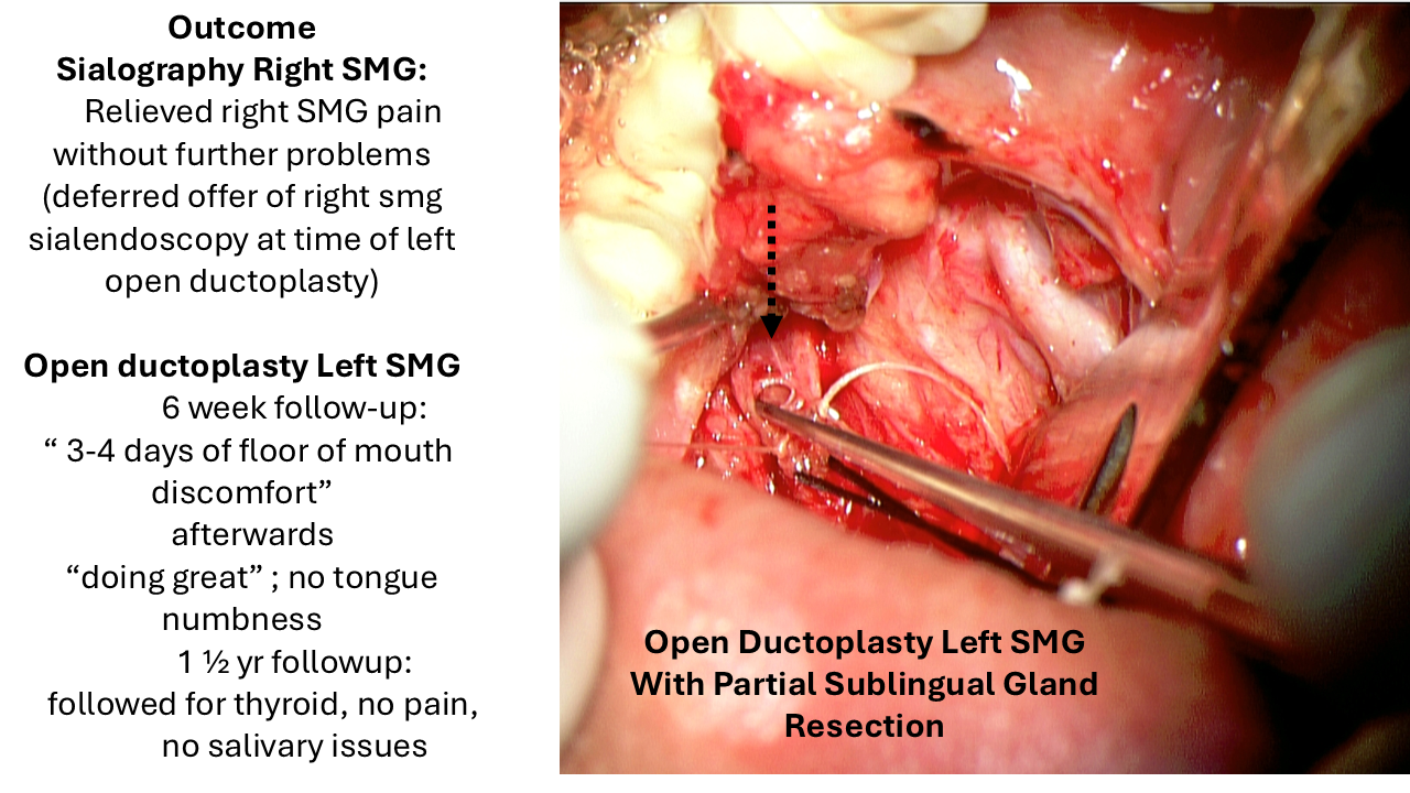 smg duct obstruction