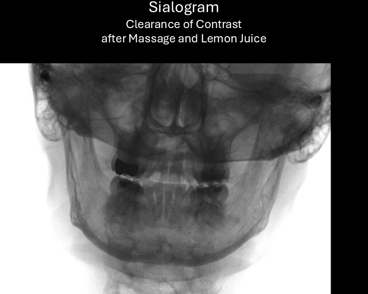 right sialogram 4