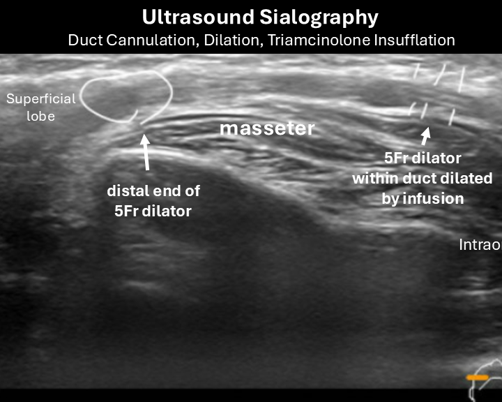 ultrasound sialography 1