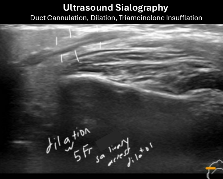 ultrasound sialography 2