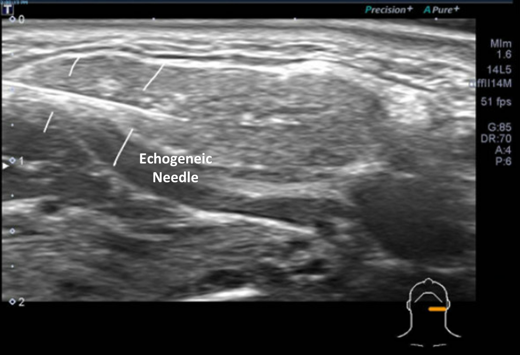 echogenic needle injection