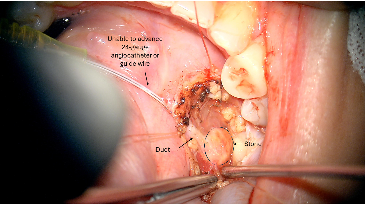 open ductoplasty for submandibular stone
