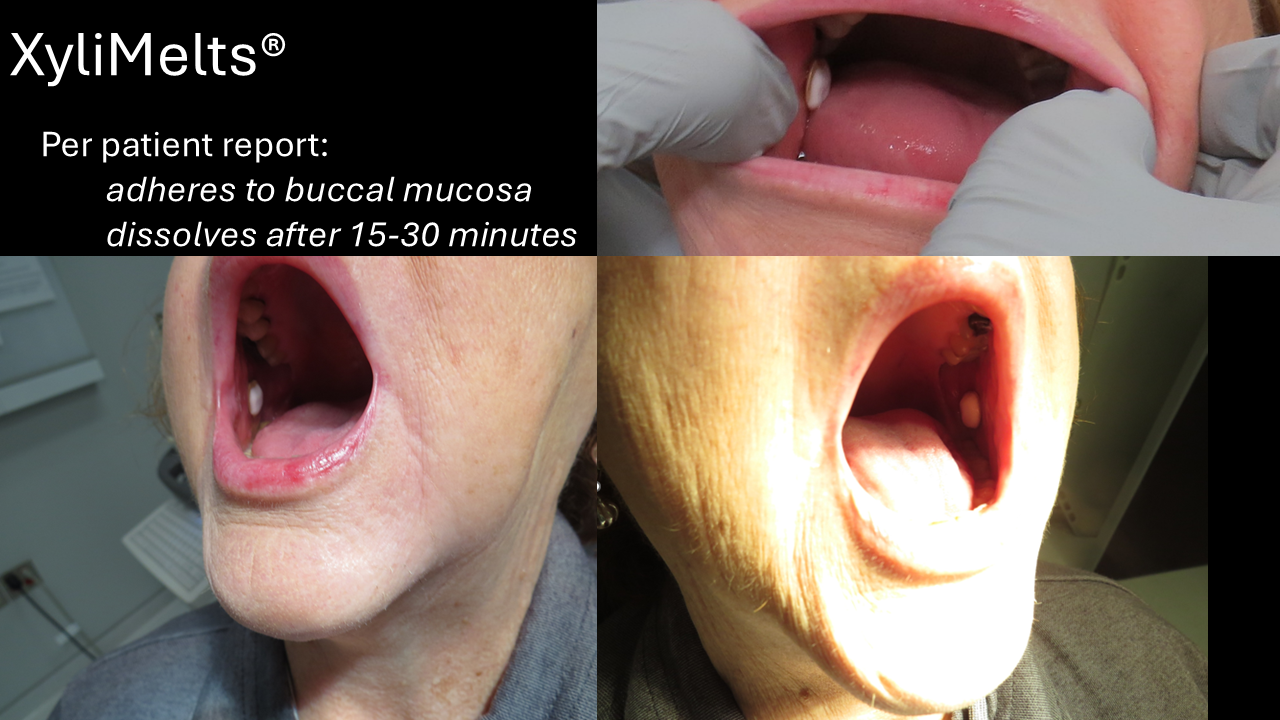 retatrutide dry mouth Dry Mouth (Xerostomia) Management | Iowa Head and Neck Protocols - Carver  College of Medicine
