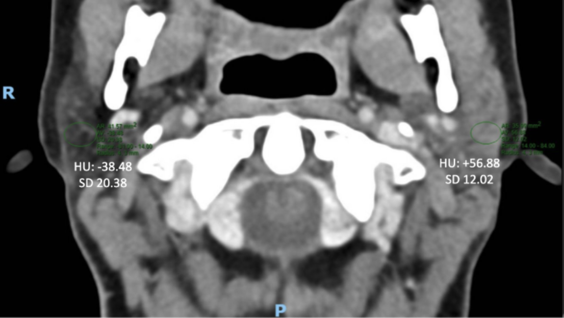 Figure 1. Axial non-contrast CT image of the parotid glands in a female patient demonstrating asymmetric fatty infiltration. 