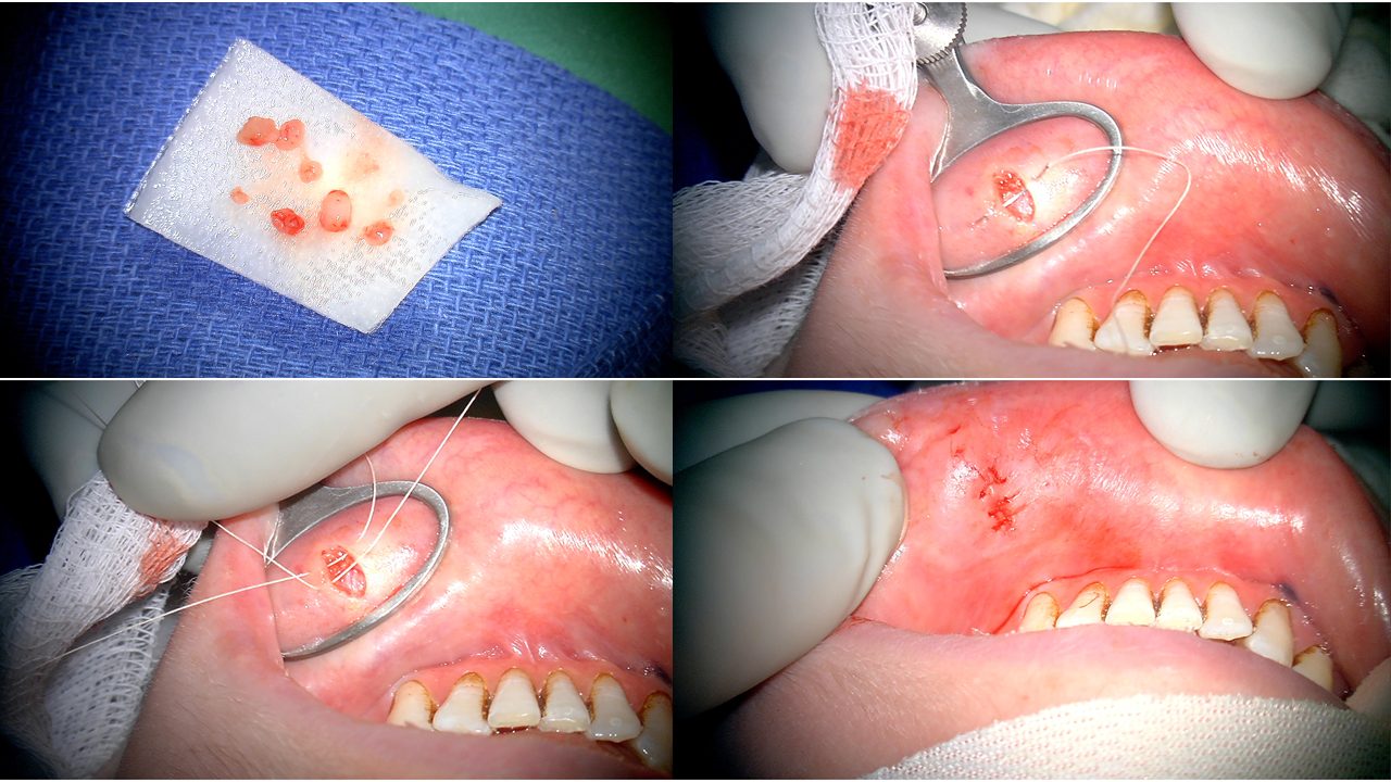 Lip Biopsy closure under microscope