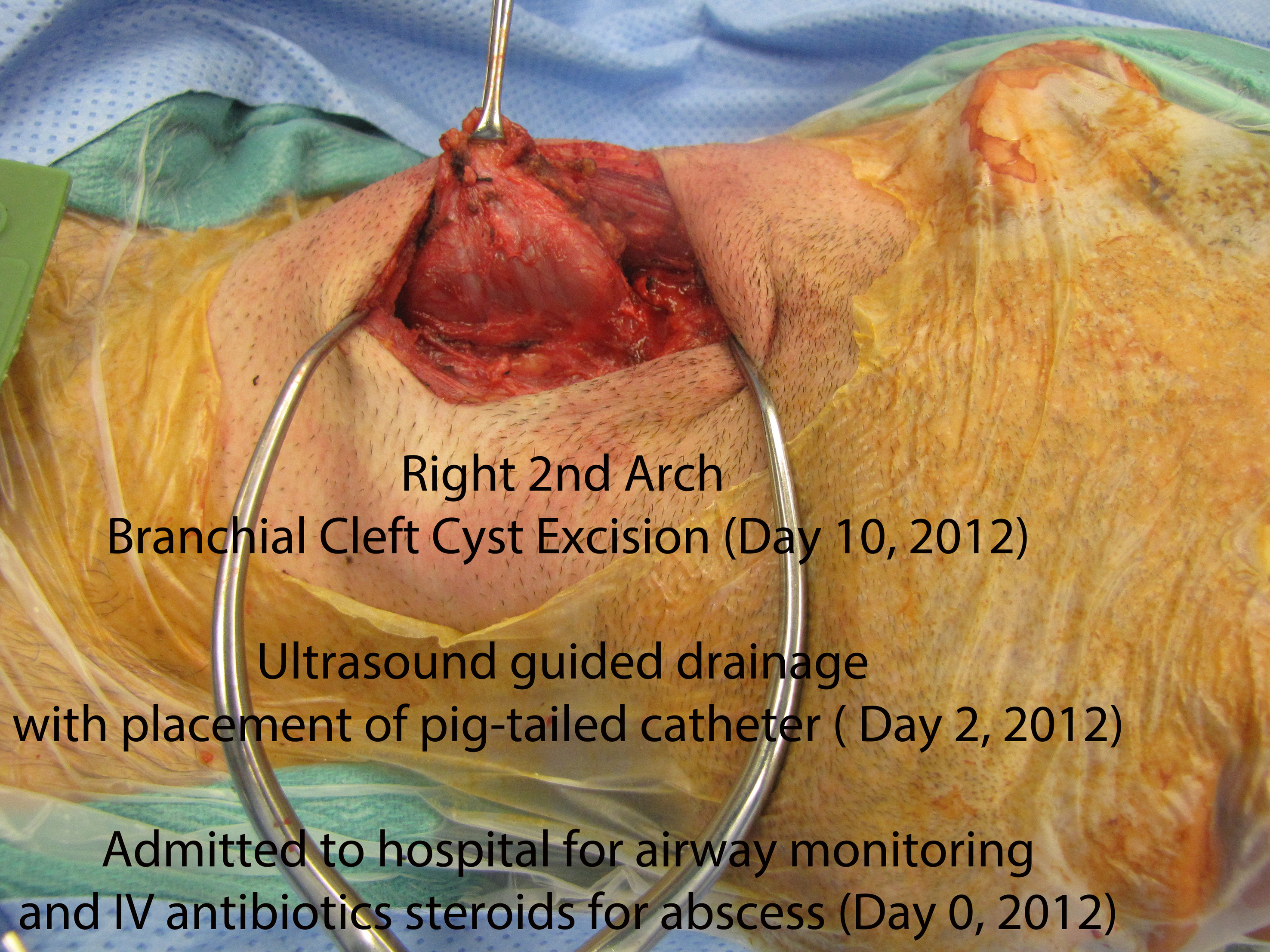 Intra-Op Resection with Clinical Course