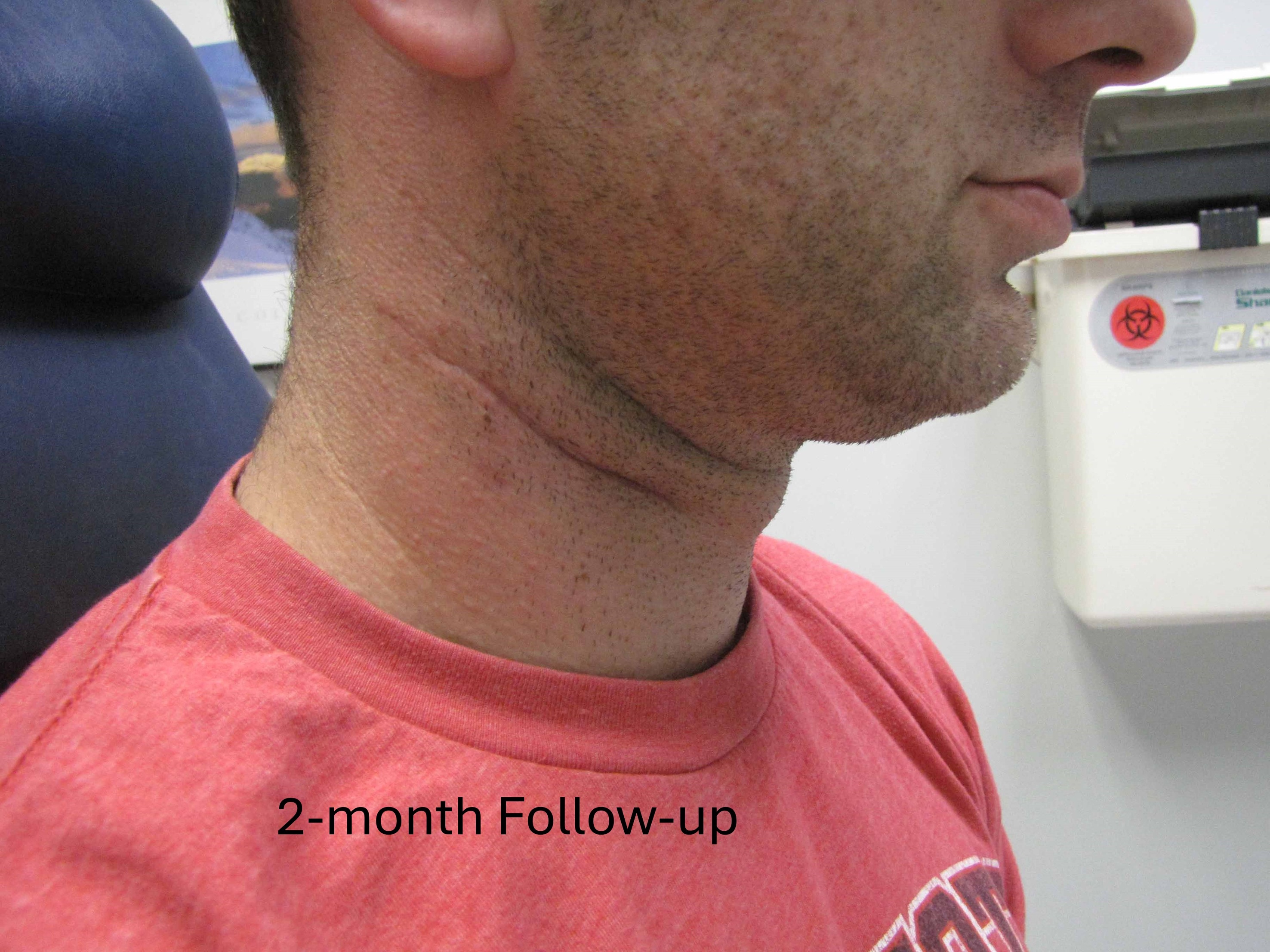 Well Healed Scar at 2 Month Follow-up