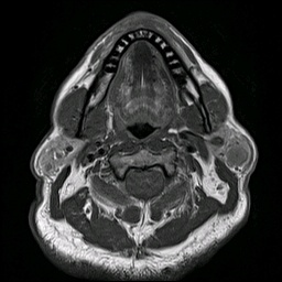 001%20mri%20tail%20parotid.jpg