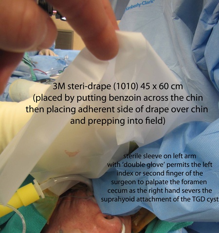 0019%20palpate%20foramen%20cecum.jpg