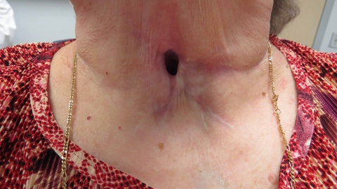 Followup 1 1/2 years postop