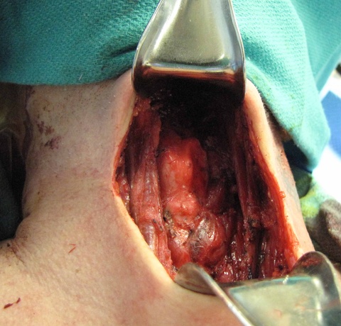 0021%20after%20resection.jpg