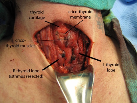0022%20anatomy%20after%20tgd%20resection.jpg