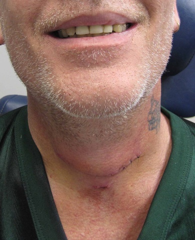 0024%20drain%20and%20sutures%20removed%20one%20week%20postop.jpg