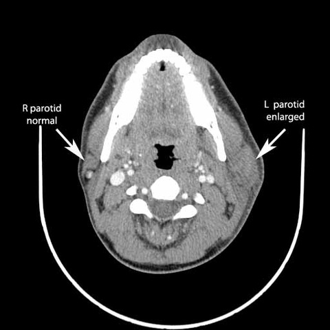005%20CT%20parotid%20swellinga.jpg 005%20CT%20parotid%20swellinga.jpg
