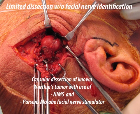 005%20a%20x%20warthins%20resection.jpg