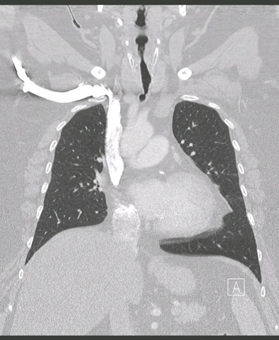 005%20trachstenosis.jpg