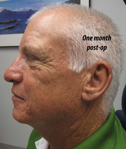 006%20one%20month%20postop.jpg