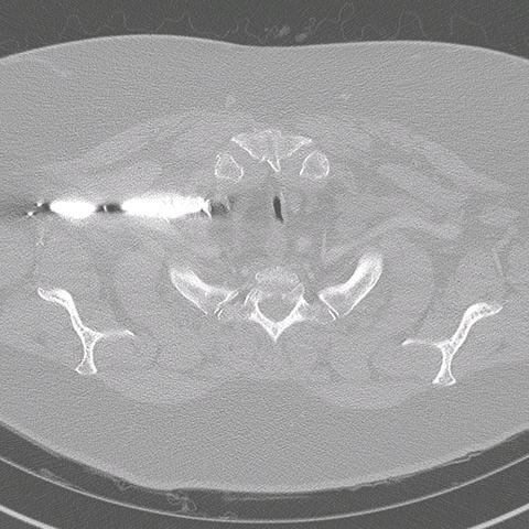 006%20trachstenosis.jpg