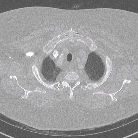 007%20trachstenosis.jpg