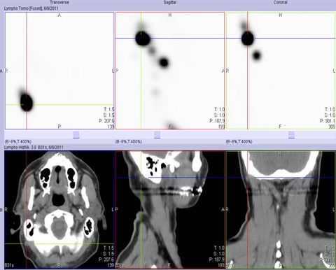 Lymphoscintigram with CT co-registration. Note the post-auricular/anterior occipital node identified within the cross-hairs on the three CT images