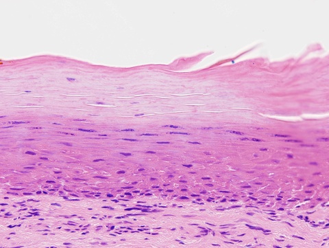 In contrast to the prior photomicrograph, this portion of the mucosa shows a densely keratotic surface without significant cytologic atypia and a regular mucosal/submucosal junction.