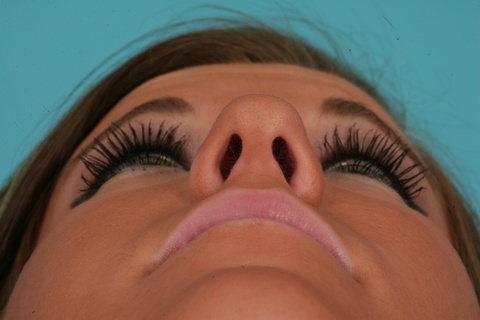 Nasal Base Preop