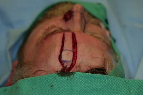 Forehead Flap incised and raised 