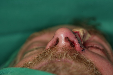   Completed Basal View  
