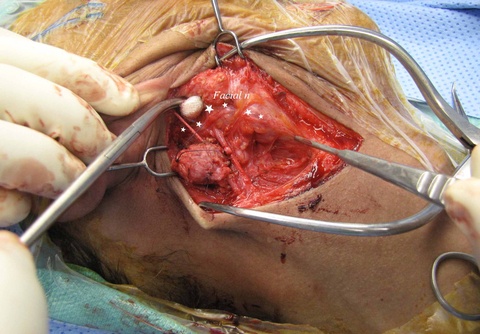 note retrograde dissection of facial nerve (marked by stars) permits resection of tail of parotid without pre-auricular incision. Also note great auricular nerve overlying benign tumor