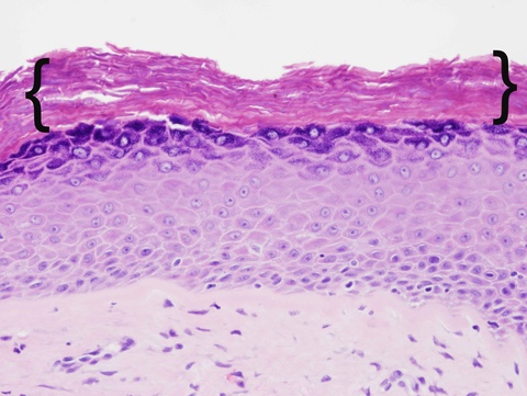 A dense layer of hyperkeratosis (braces) tops this mucosa, making it appear more skin-like rather than mucosal.
